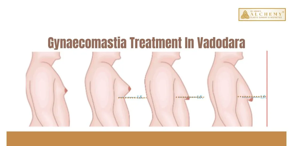 gynaecomastia treatment in vadodara