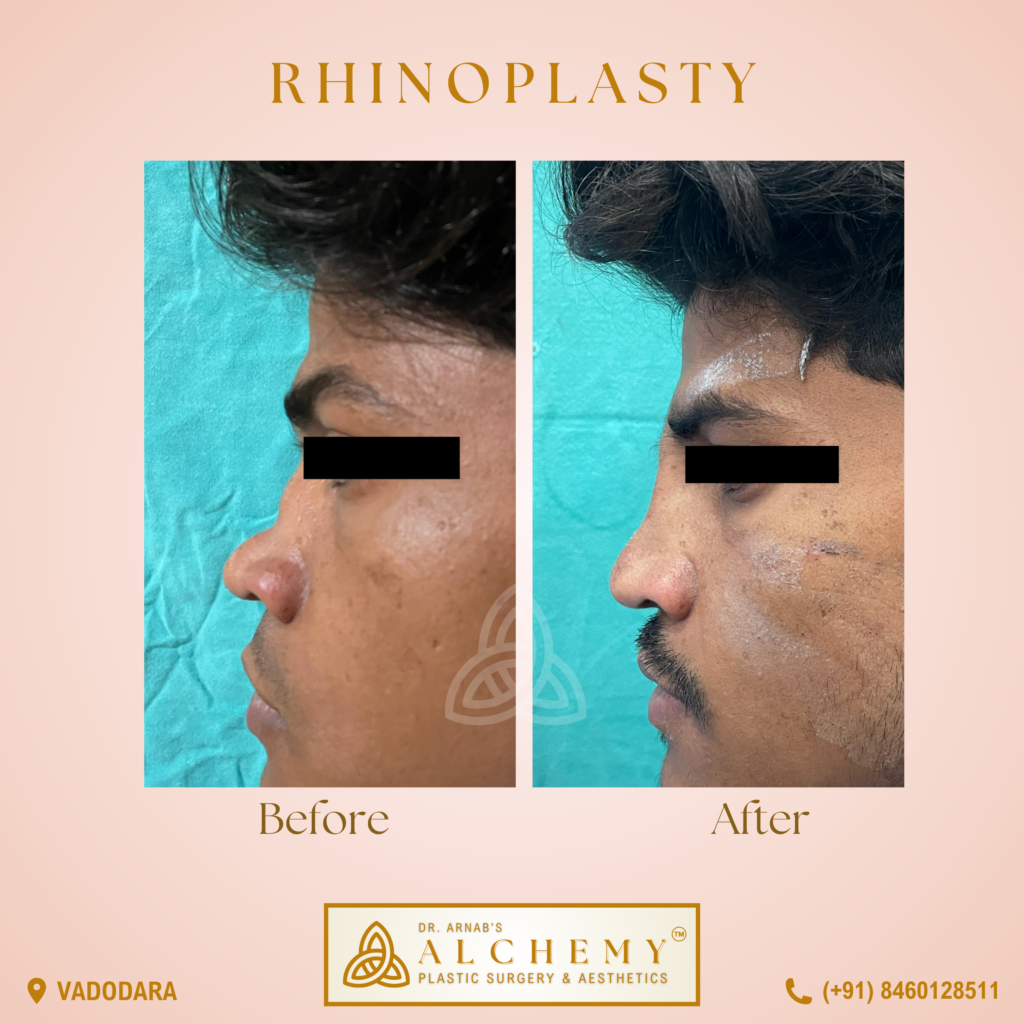 Rhinoplasty_male