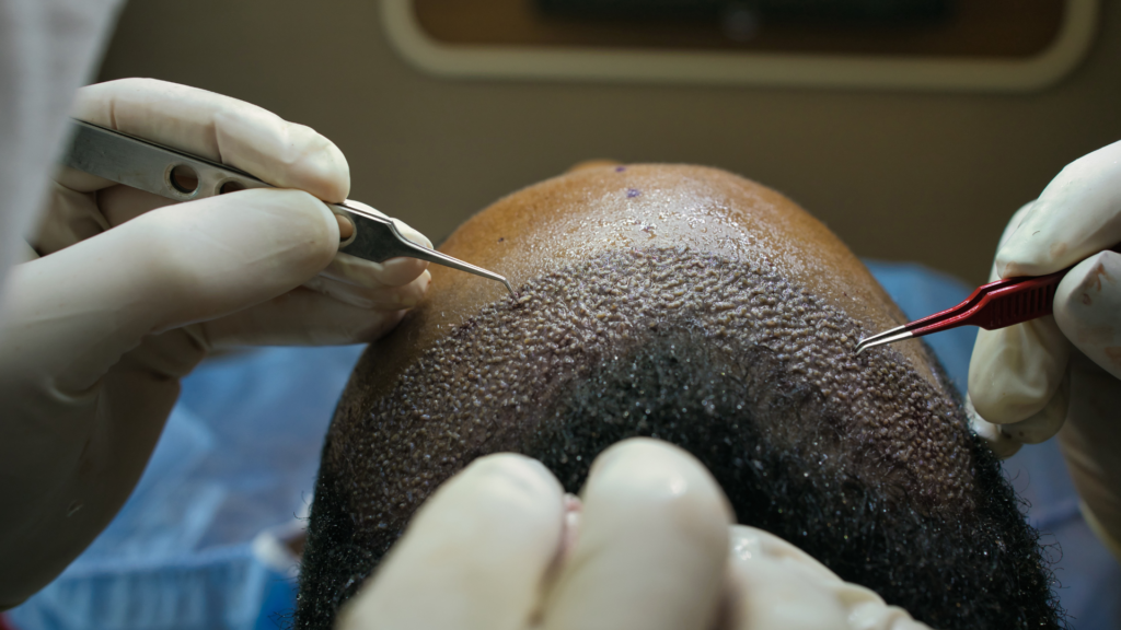 6 Hair Transplantation