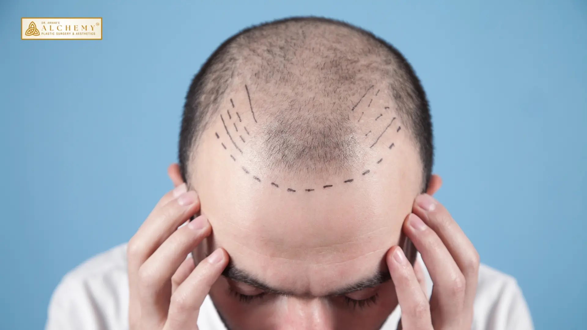 Best hair Transplant treatment in vadodara