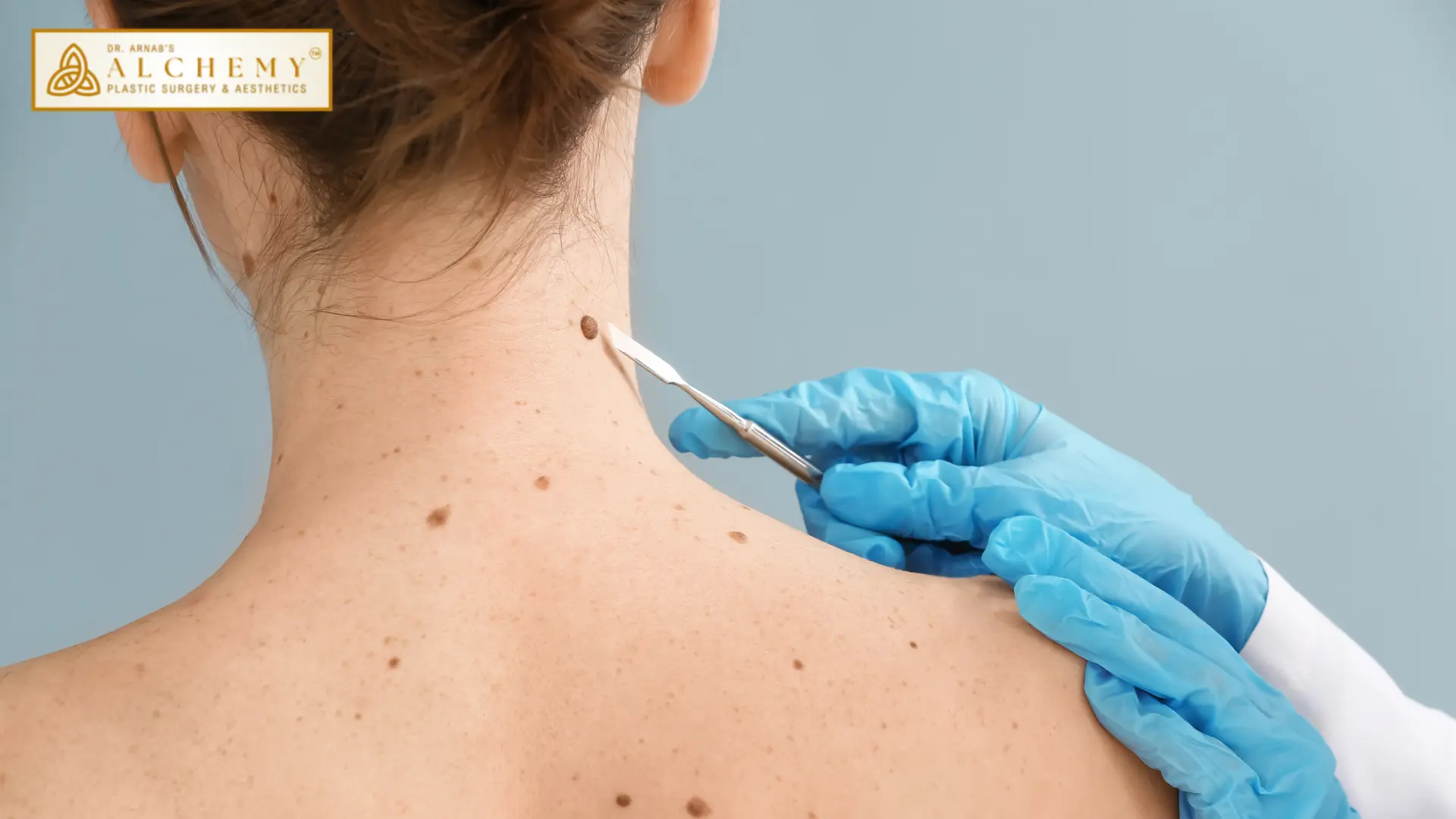 Mole Excision Treatment In Vadodara