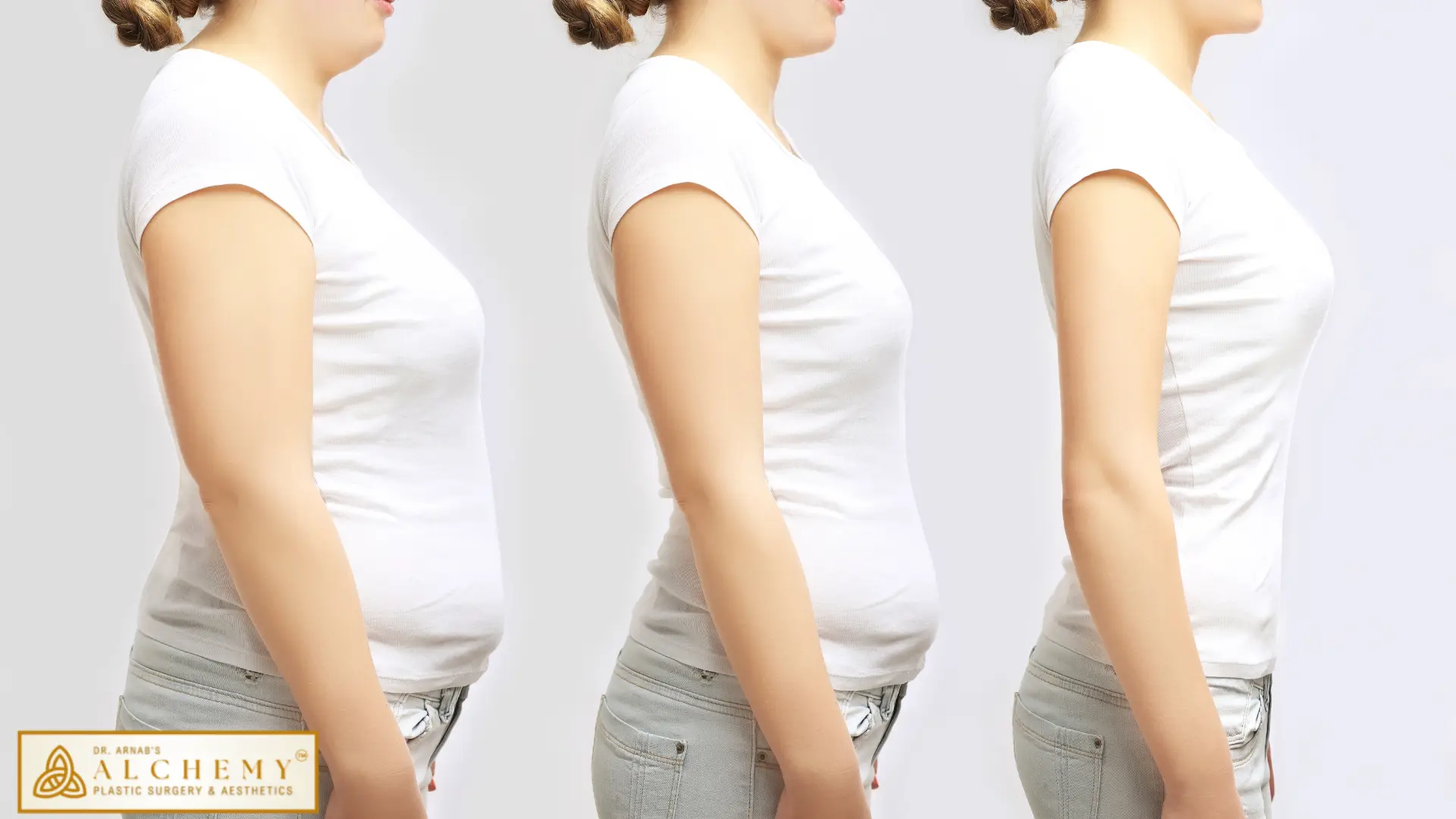 Top Liposuction Treatment In Vadodara